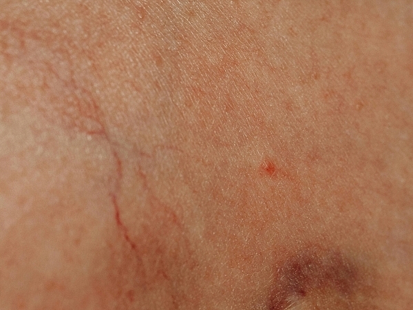 How to Choose the Right Varicose Vein Specialist for Your Needs