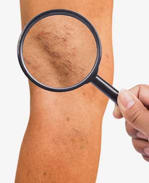 Sclerotherapy of Spider Veins - Elite Veins, NY