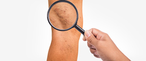 Sclerotherapy of Spider Veins Near Me in NYC
