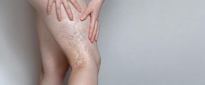Sclerotherapy of Varicose Veins Near Me in New York, NY