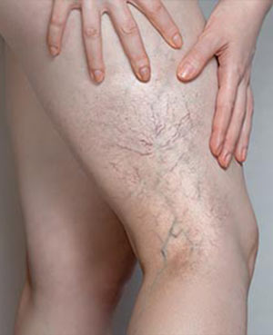 Sclerotherapy of Varicose Veins - Elite Veins NY in NYC